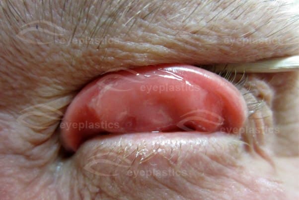 Close-up of the lax upper eyelid everting β soft rubbery tarsus