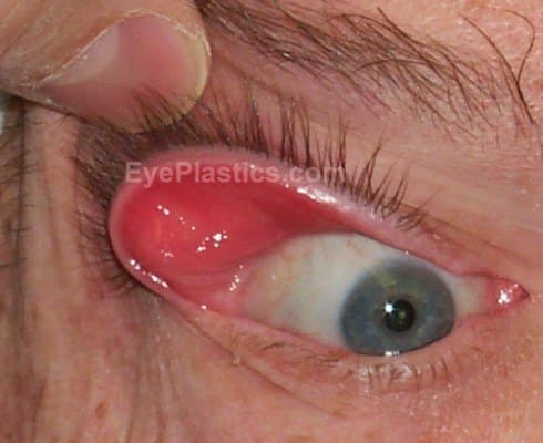 Easy eversion of the upper eyelid with only minimal upward traction β the hallmark sign of floppy eyelid syndrome