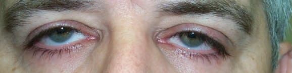 Lash ptosis β downward-pointing upper lashes
