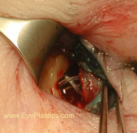 DCR surgery β exposure of the lacrimal sac region