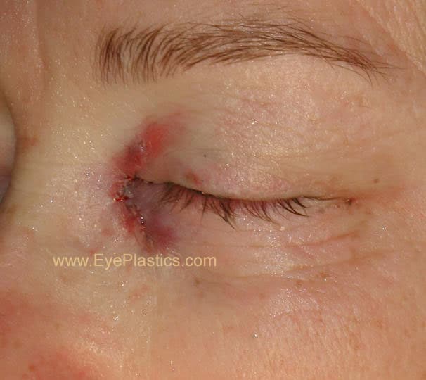 DCR surgery β the opened lacrimal sac and new passage into the nose
