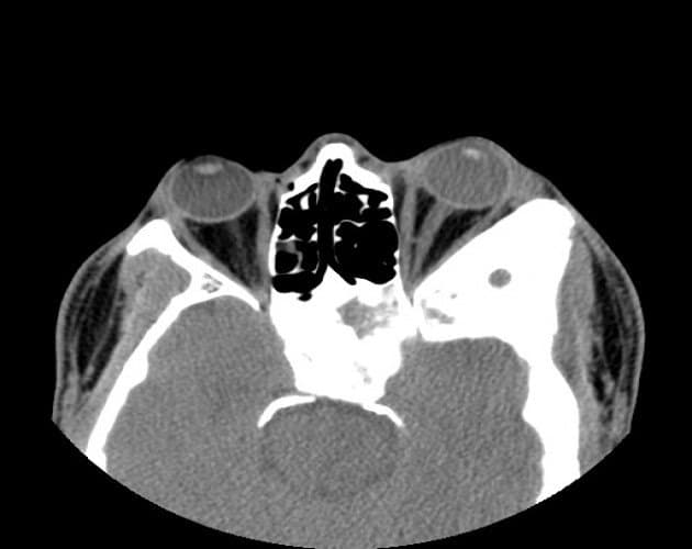 CT of orbital fibrous dysplasia โ bony reshaping of the orbit