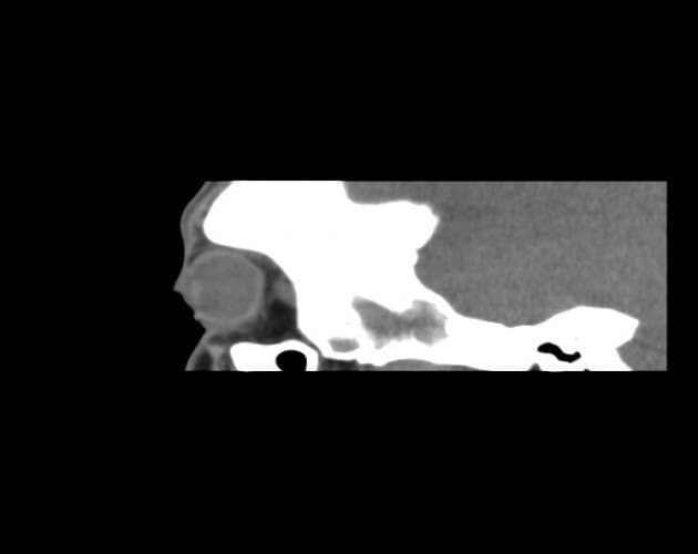 CT โ ground-glass expansion of orbital bone characteristic of fibrous dysplasia