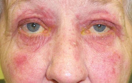 Facial rosacea โ erythema and telangiectasias