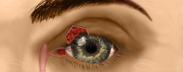 Pentagonal Wedge Resection β Tightening the Lax Upper Eyelid β slide 1 of 4