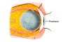 Anophthalmos | implant | scleral shell